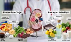 Tak Cuma Kurang Minum, Ternyata 3 Makanan Harian Ini Jadi Pemicu Batu Ginjal